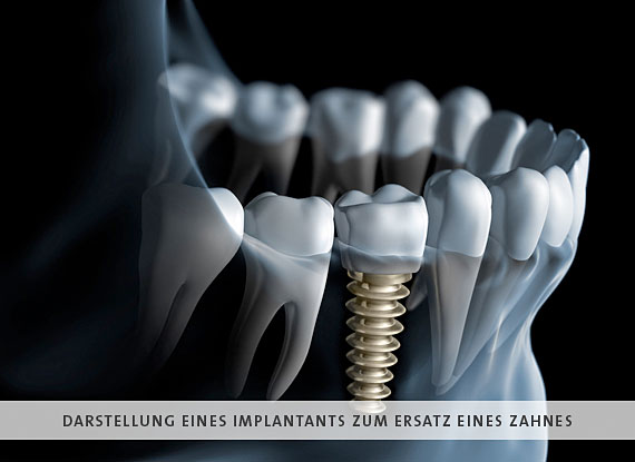Bild Implantologie, minimalinvasive Implantologie, Keramikimplantate, Sofortbelastbare Implantate, Praxis für Zahnheilkunde, Traunreut, Fabritius